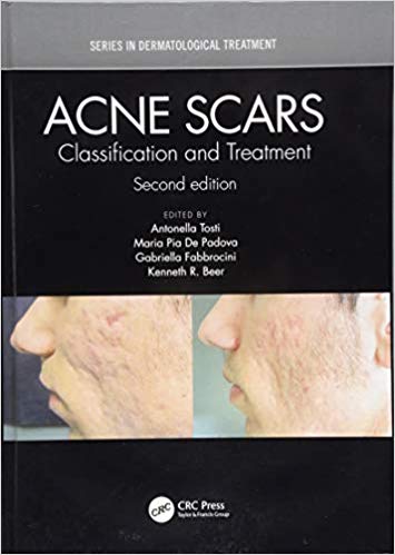 Acne Scars: Classification and Treatment 2/E 2019
