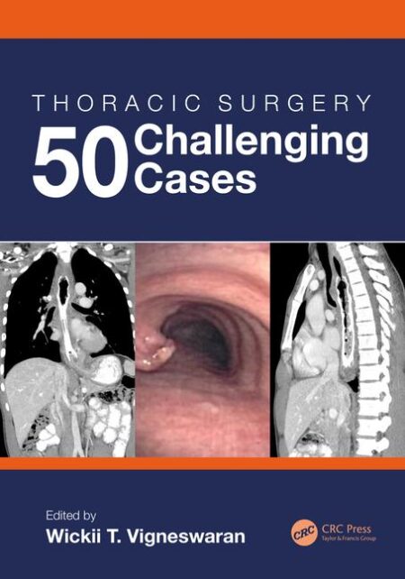 Thoracic Surgery: 50 Challenging cases 2020